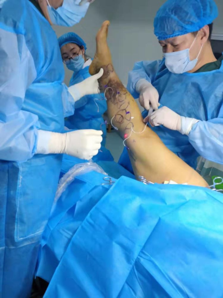 微创治疗静脉曲张（老烂腿），不留疤痕